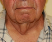 Feel Beautiful - Necklift San Diego Case 12 - Before Photo